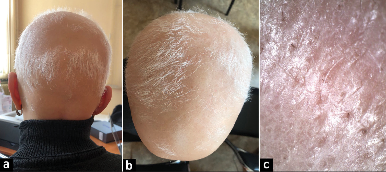 (a and b) Case 2 at baseline, severity of alopecia tool 82. (c) Trichoscopy of case 2 at base line: Yellow dots, black dots, broken hairs, and vellus hairs.