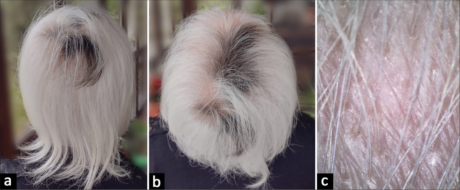 (a and b) Case 2 at follow-up, severity of alopecia tool 19. (c) Trichoscopy of case 2 at follow-up: Upright regrowing hairs, terminal hairs.