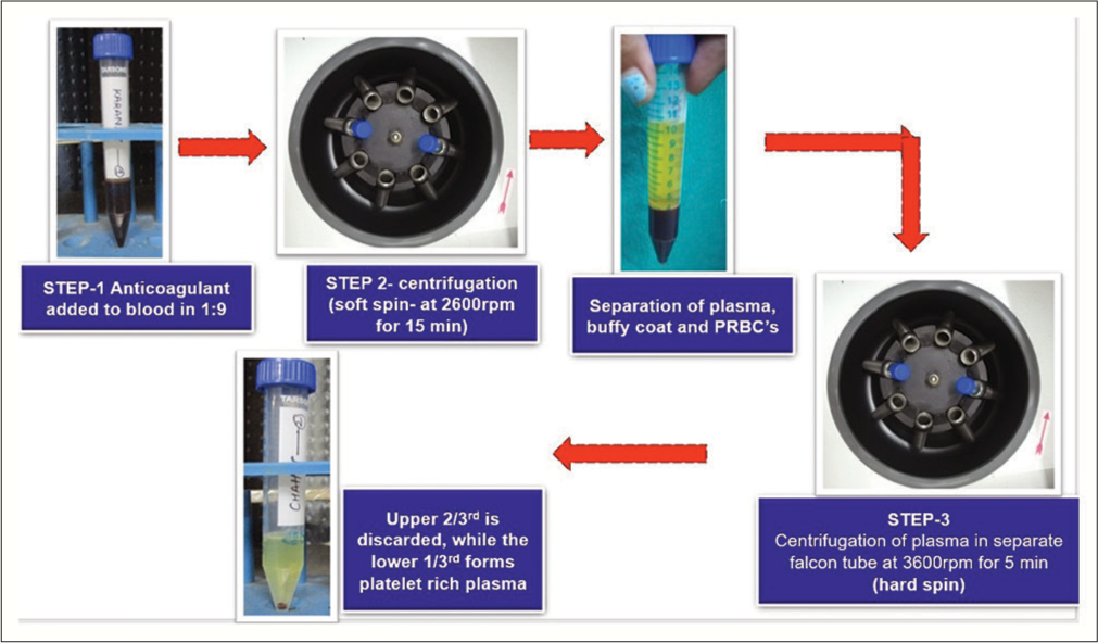 Steps for preparation of autologous platelet rich plasma using double spin method. PRBC: Peripheral Red Blood Cell.