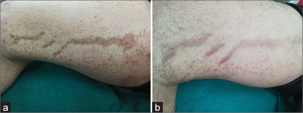 (a) A 24-year-old male allotted to Group A (Microneedling alone). Clinical appearance of stretch marks over the right thigh (medial side) at the start of the study. (b) Clinical appearance of stretch marks present over right thigh (medial side) at the end of study (20 weeks).