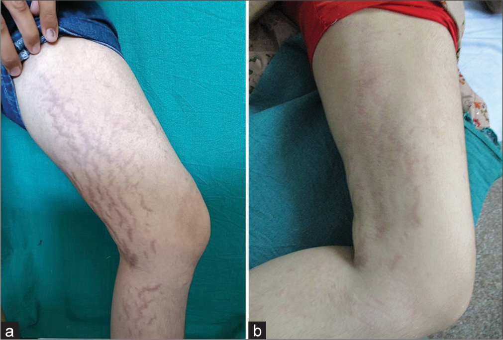 (a) A 21-year-old female allotted to Group B (Microneedling with autologous platelet rich plasma). Clinical appearance of stretch marks over the left leg at the start of the study. (b) Clinical appearance of stretch marks present over the left leg at the end of study (20 weeks).