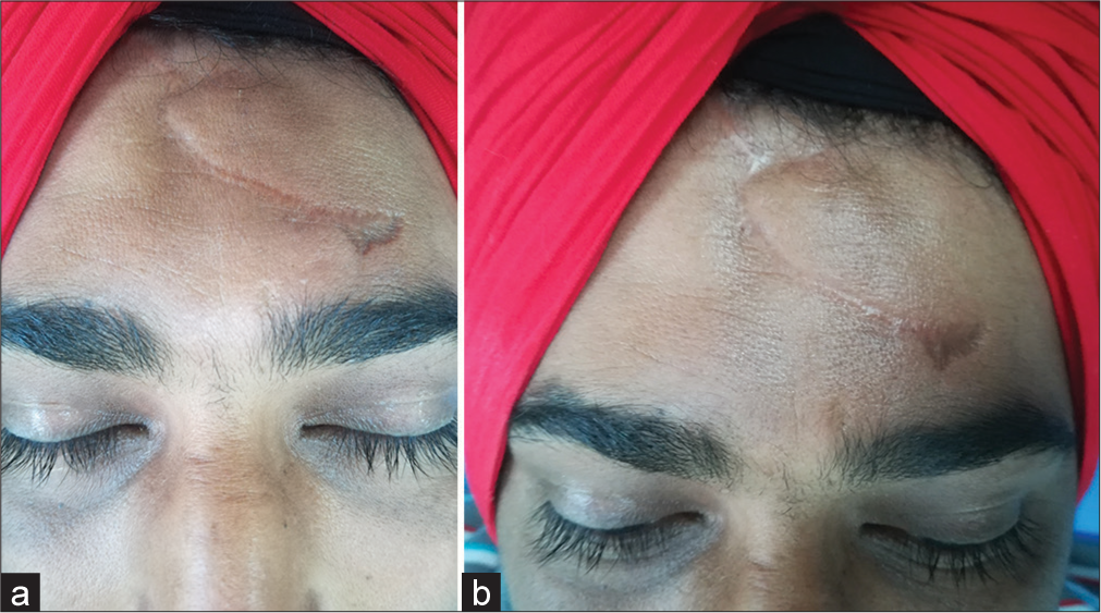 (a) A 32-year-old male allotted to Group A (Microneedling alone). Clinical appearance of post-surgery scar marks present over the forehead at the start of the study. (b) Clinical appearance of post-surgery scar marks present over the forehead after 20 weeks (at the end of the study).