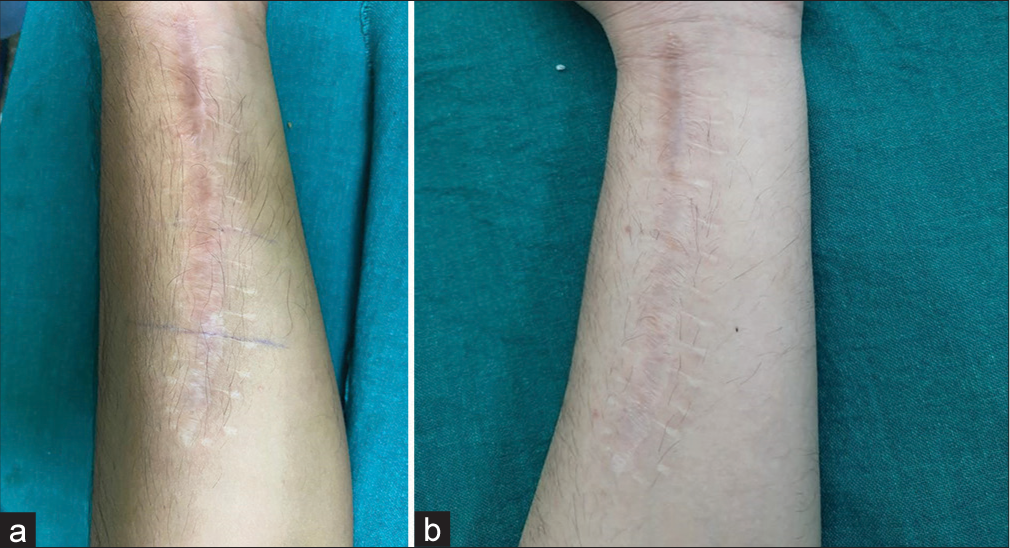 (a) A 21-year-old male allotted to Group B (Microneedling with autologous platelet rich plasma). Clinical appearance of post-surgery scar marks present over the flexural aspect over the left forearm at the start of the study. (b) Clinical appearance of post-surgery scar mark present over flexural aspect over left forearm after 20 weeks (at the end of the study).