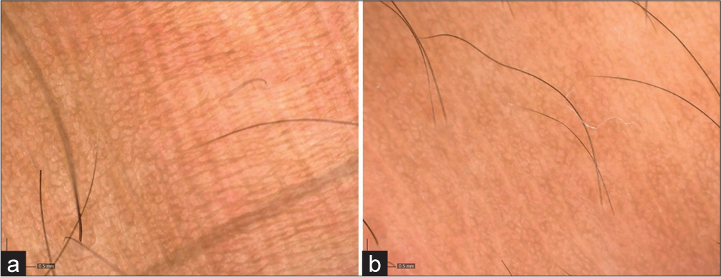 (a) Dermoscopy findings (magnification: ×63) of the stretch marks at the start of the study showing atrophic skin with loss of pigmentation pattern. (b) Dermoscopy findings (magnification: ×63) of the stretch marks at the end of study (20 weeks) showing improvement in atrophy and pigmentation.