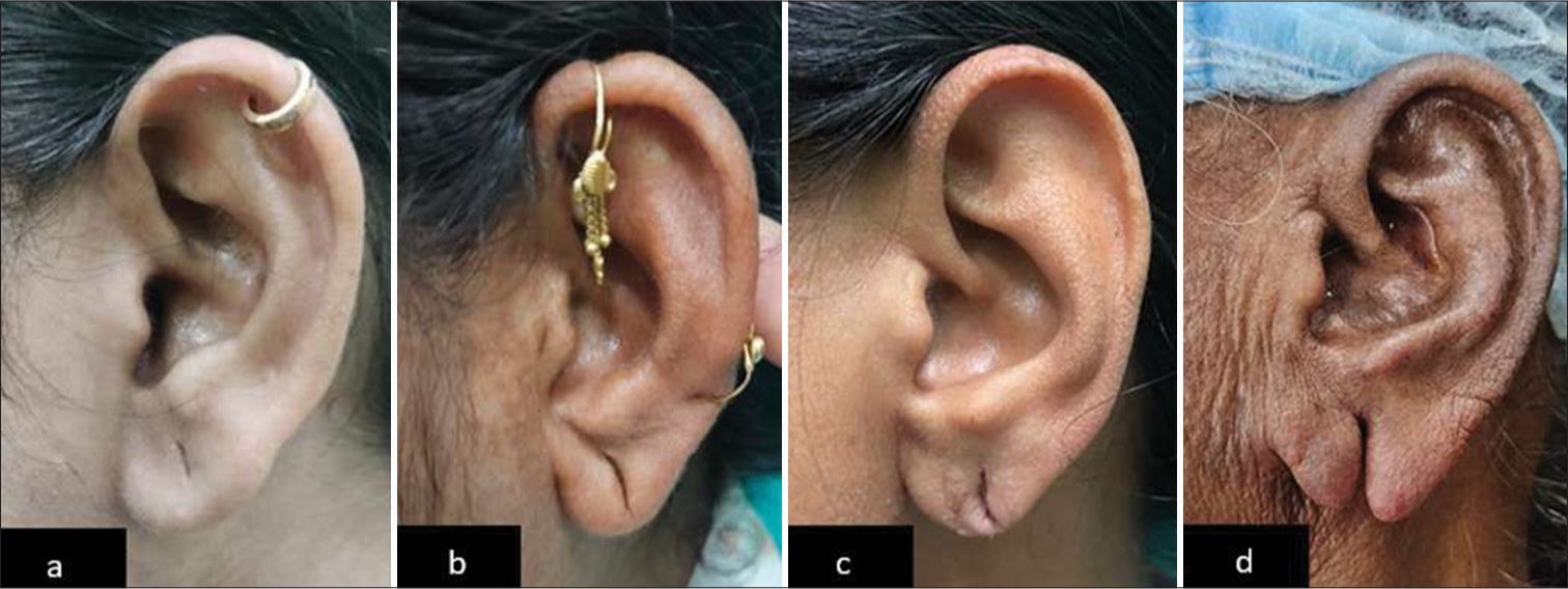 Types of Earlobe tear: (a) Type I: Elongated perforation with length less than that of normal tissue, (b) Type IIA: Elongated perforation with length more than that of normal tissue measured from the lower end of the cleft to the inferior margin of the earlobe, (c) Type IIB: Inferior contour abnormal, and (d) Type III- Total earlobe tear.