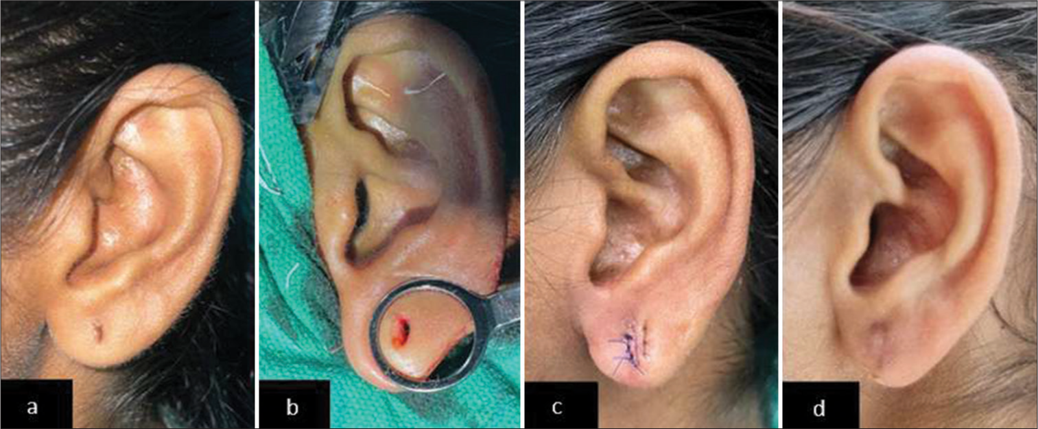 (a) Pre-operative photo showing Type I deformity, (b) intraoperative photo showing a through and through a slit in the earlobe after punching, (c) post-operative photo after closing the slit with vertical mattress sutures, and (d) post-operative picture on day 10.