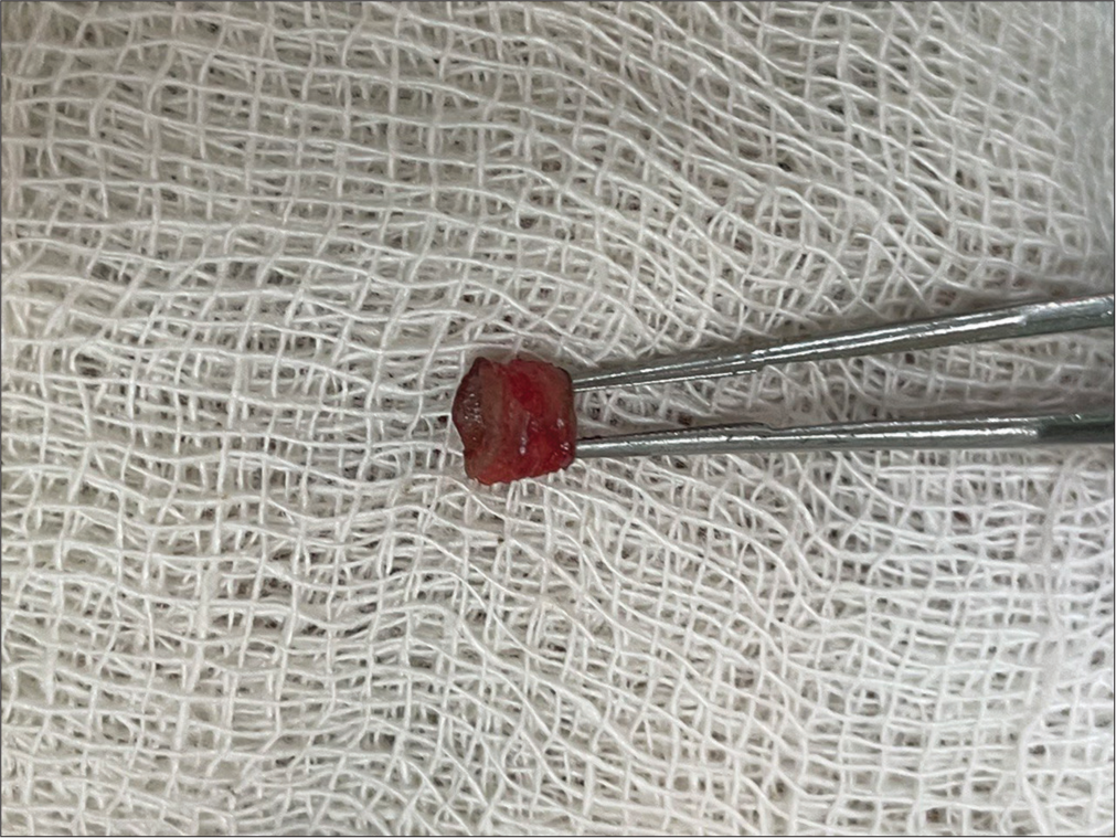 Cylindrical tissue sample with the skin at both ends and the cleft at its center along its length.