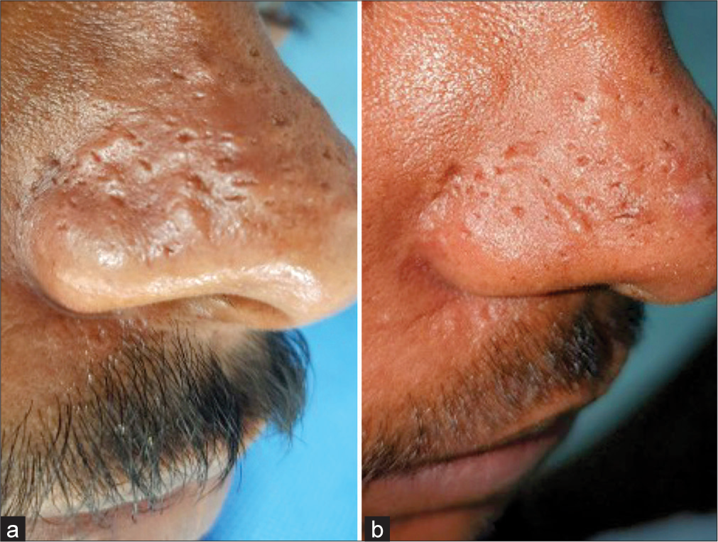 Result of radiofrequency epilation using acupuncture needles for papular acne scars in a patient with previous scarring due to syringe needle-based radiofrequency ablation. (a) Before and (b) after 1 session. No pigmentation or scarring was seen using thin acupuncture needles, in contrast with the previous session with syringe needle needle-based ablation.