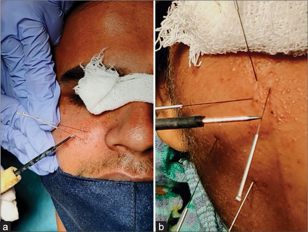 Acupuncture needles for intralesional radiofrequency of multiple solid lesions. (a) Acupuncture needles are placed simultaneously over multiple small solid lesions which can be burnt with minimum peripheral damage and pigmentation in milia or syringomas. (b) Close up view.