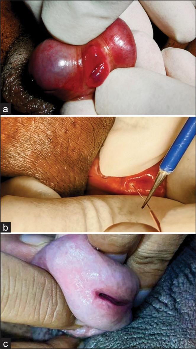 (a-c) Usage of long bent acupuncture needles to access intrameatal warts.