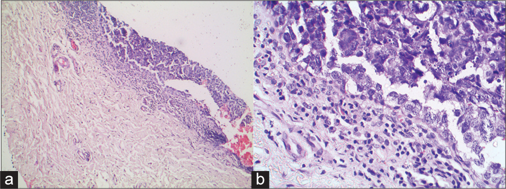 (a) Histopathology of conjunctival epithelium showing full-thickness dysplasia (Hematoxylin-eosin stain; magnification × 40), (b) Histopathology of conjunctival epithelium showing multiple dysplastic cells (Hematoxylin-eosin stain; magnification × 100).