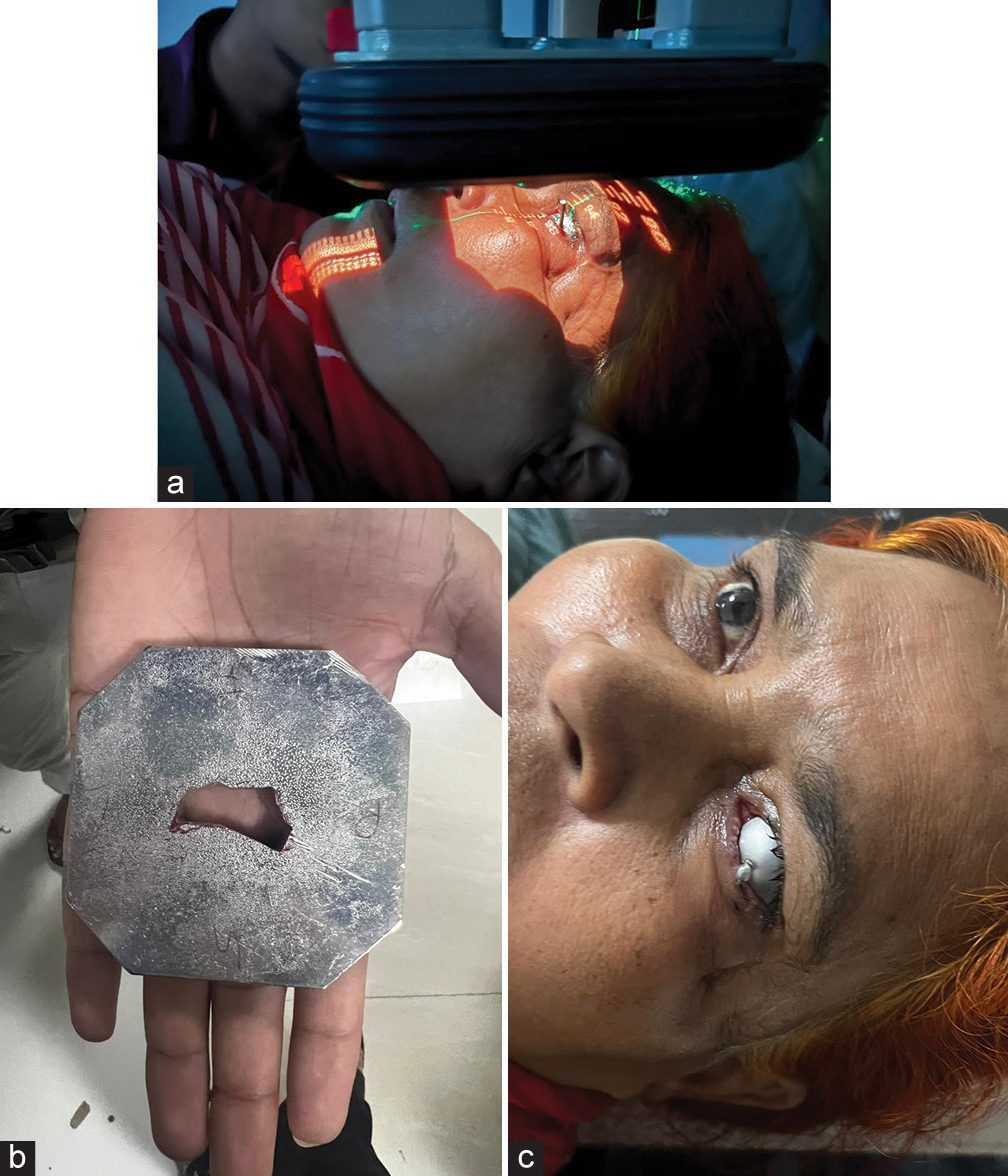 (a) Patient receiving external beam radiotherapy. The eye-shield was used with the Cerrobend shield to immobilize the eye during the whole treatment fraction. (b) Cerrobend shield. (c) Close up view of patient with the eye shield.