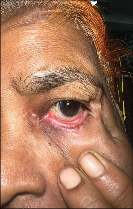 Six weeks after external beam radiotherapy, the patient’s left eye shows complete resolution of injection edema of the left eye.