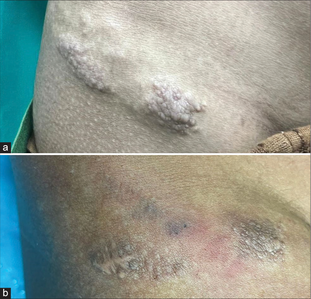 (a) Multiple skin-colored to erythematous papules coalescing to form plaques over the right inguinal region. (b) Patient follow-up image after the second session of embolization therapy.