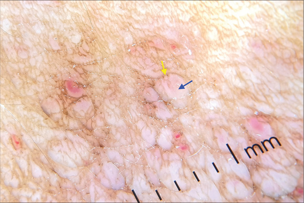 Multiple lacunae (blue arrow) with pale septa (yellow arrow).