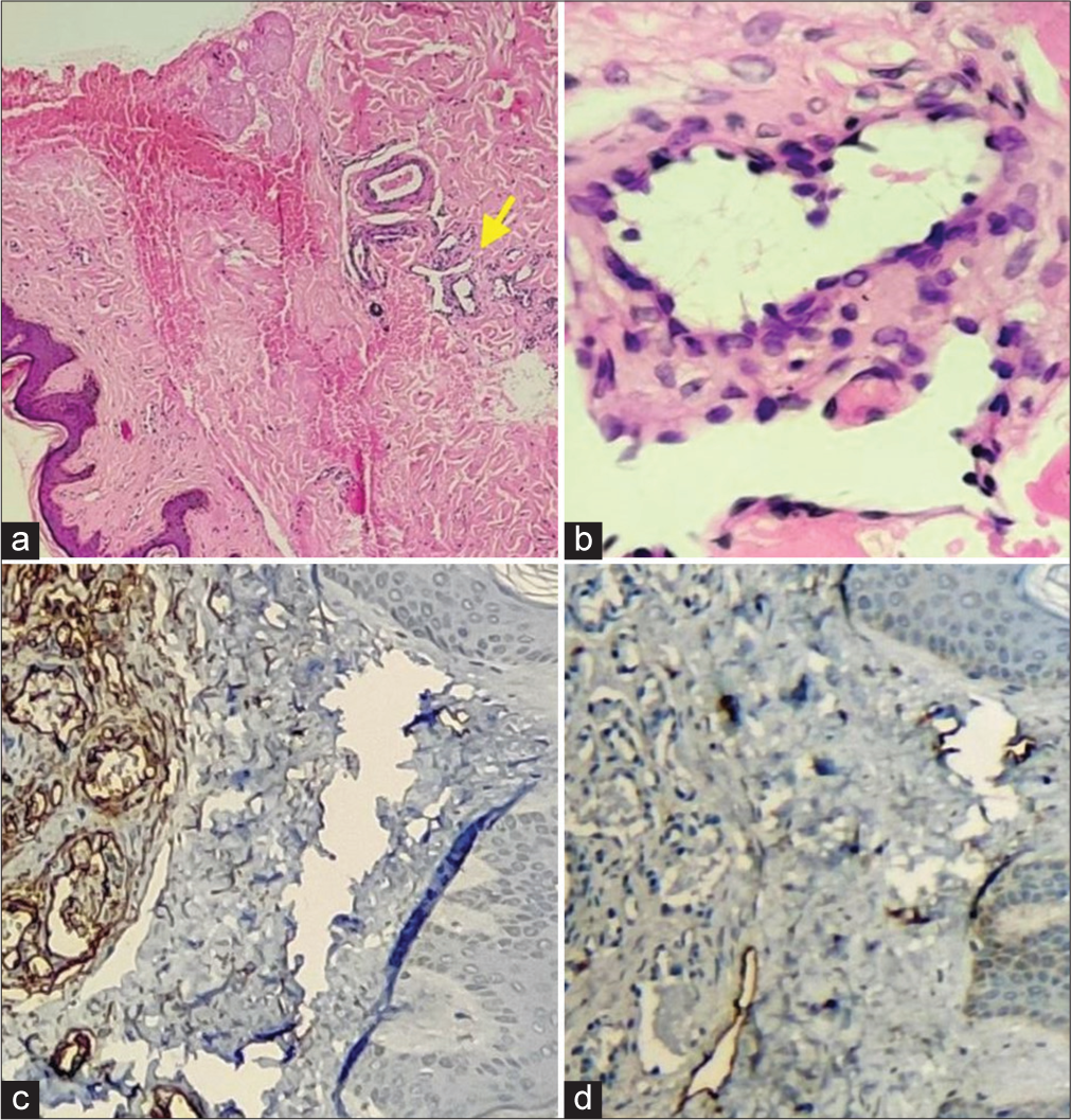 (a) Hematoxylin and eosin [H&E], ×40): The epidermis and the adnexa show normal histomorphology with numerous proliferating blood vessels (yellow arrow) with areas of hemorrhage seen in the collagenous stroma of the dermis. (b) (H&E, ×400): The proliferating blood vessels show a single layer of endothelium in the collagenous stroma. (c) The immunohistochemistry with CD 34 showed increased uptake and (d) D2-40 showed decreased uptake over the vascular channels.