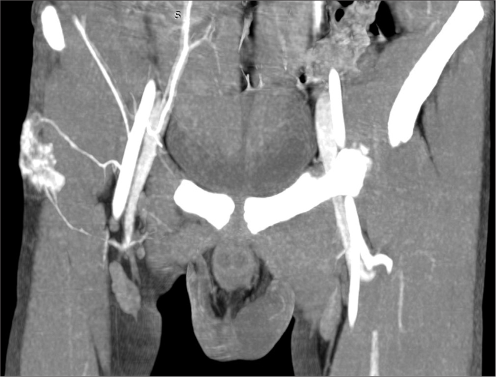 Contrast-enhanced computed tomography showing intensely enhancing lesion in the anterolateral aspect of the proximal thigh with arterial and venous drainage from the right circumflex femoral artery and vein.