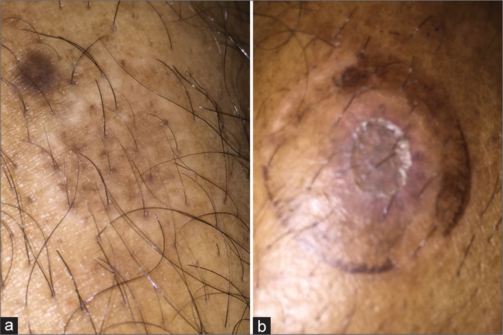 (a) The pigmentation of donor sites without epidermal grafting showing patchy and perifollicular pigmentation and (b) diffuse pigmentation after epidermal grafting.