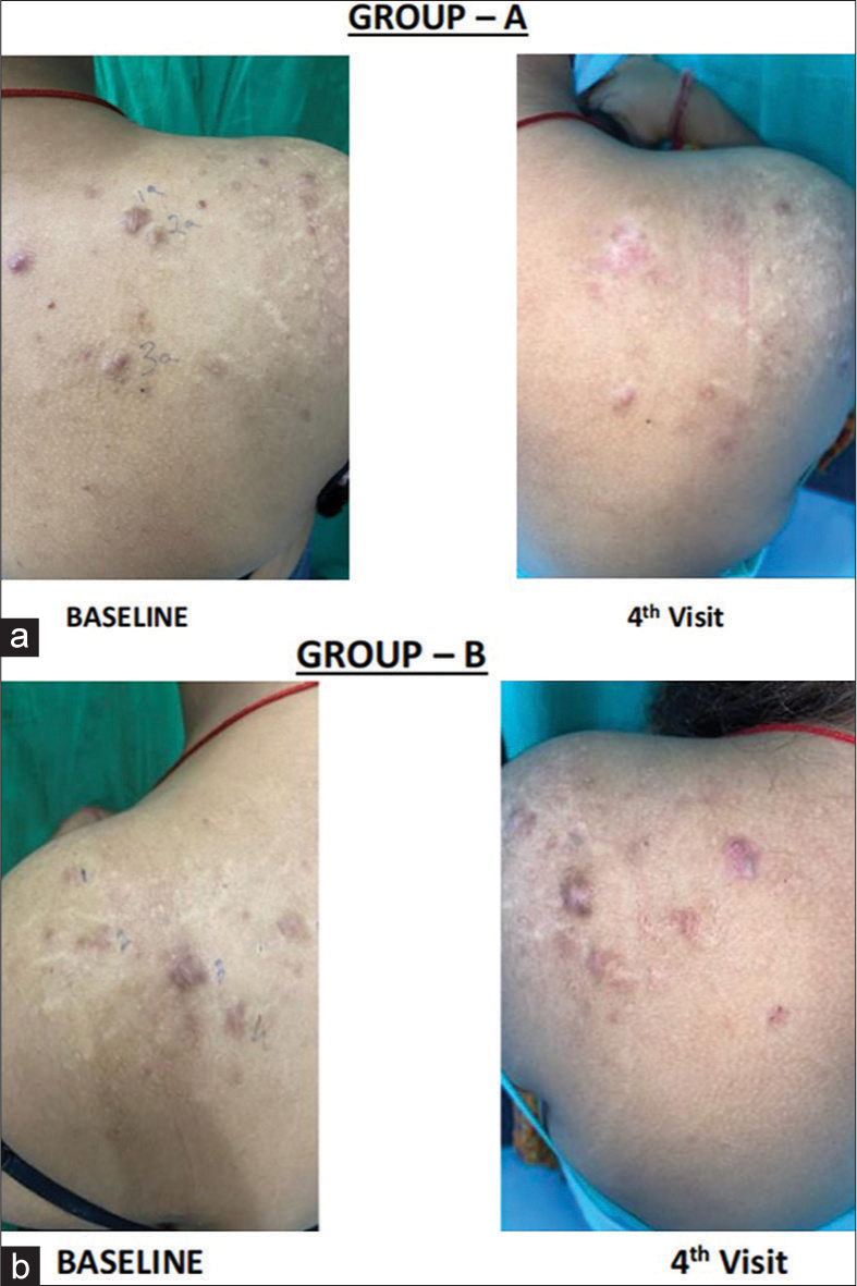 (a) Clinical images showing the response of each visit in the triamcinolone acetonide group. (b) Clinical images showing the response of each visit in the vitamin D group.