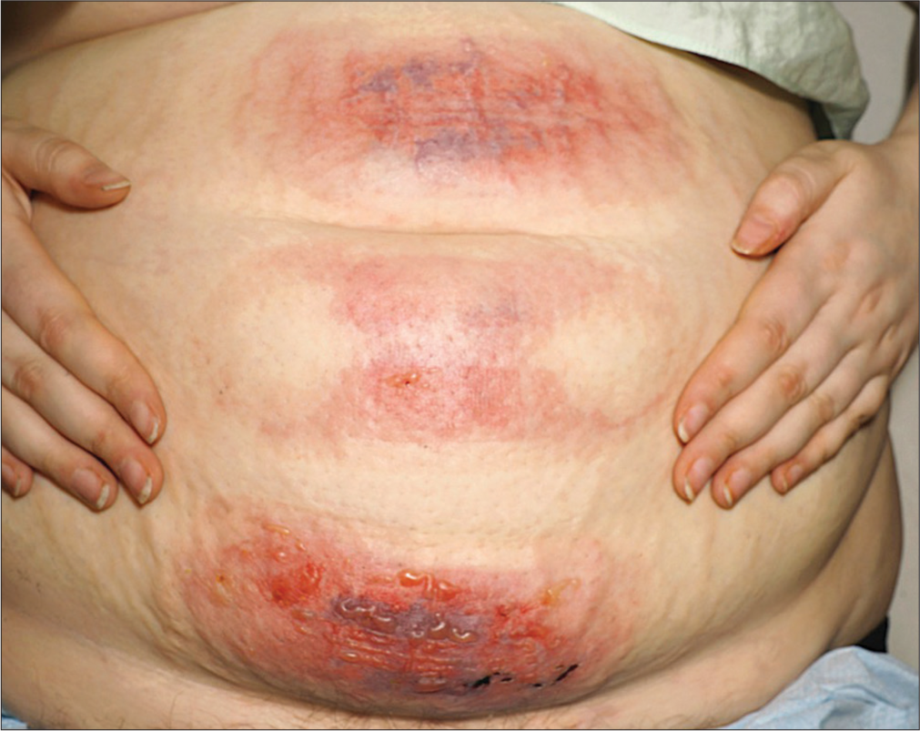 Burns to the abdomen with clearly delineated margins where the skin was in contact with cryolipolysis machine. Images taken 24 hours post-injury.