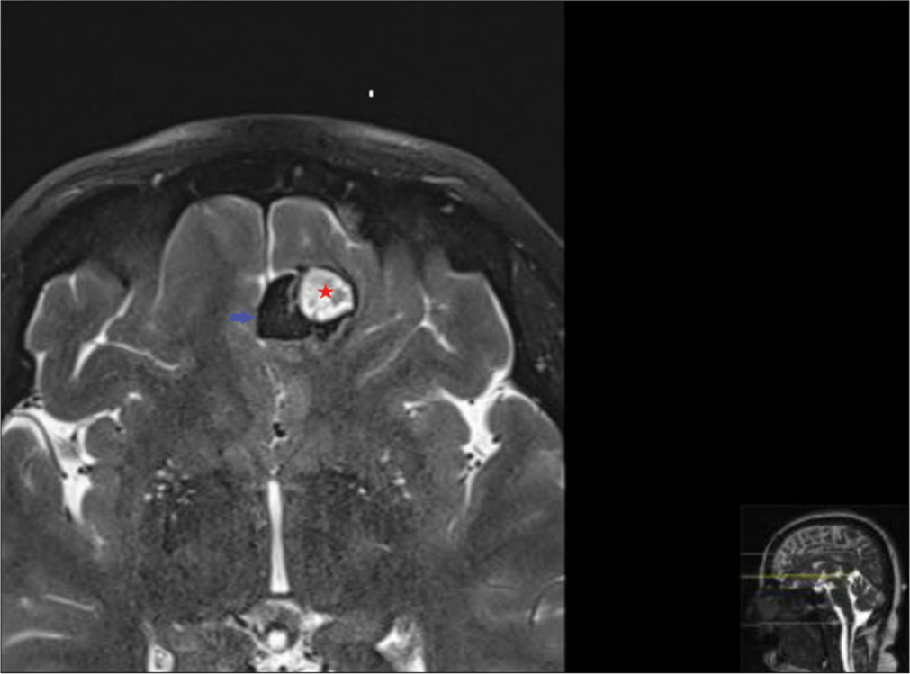 Axial fat suppressed T2-weighted magnetic resonance imaging (MRI) showing lesion located in the left olfactory sulcus with hypointensity corresponding to the ossified area in the medial (blue arrow) and cystic hyperintensity in the lateral (red star).