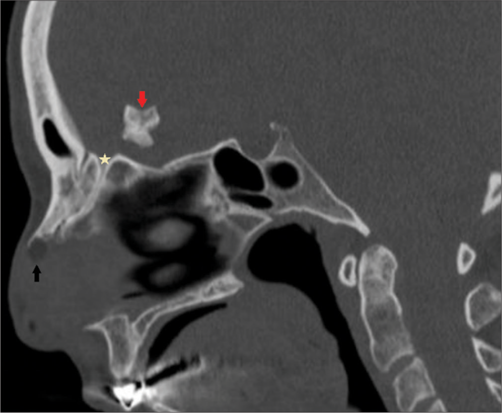 Sagittal reformatted computed tomography (CT) showing intracranial ossified area (red arrow), the canal of the atretic sinus tract extending within the frontal bone (yellow star) and nodular fat density in the nasal dorsum (black arrow).