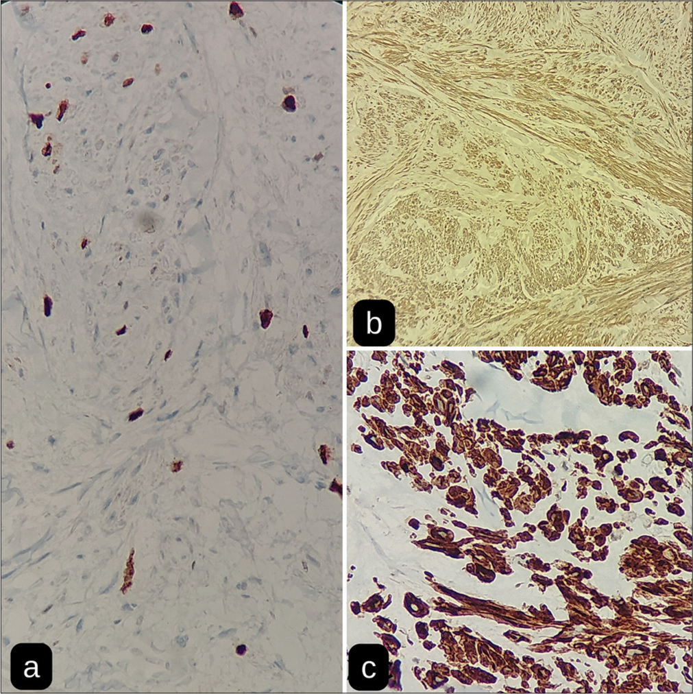 (a) Kiel-67 (Ki-67 Stain) stain, (b) Smooth muscle actin (SMA) stain, and (c) Desmin stain.