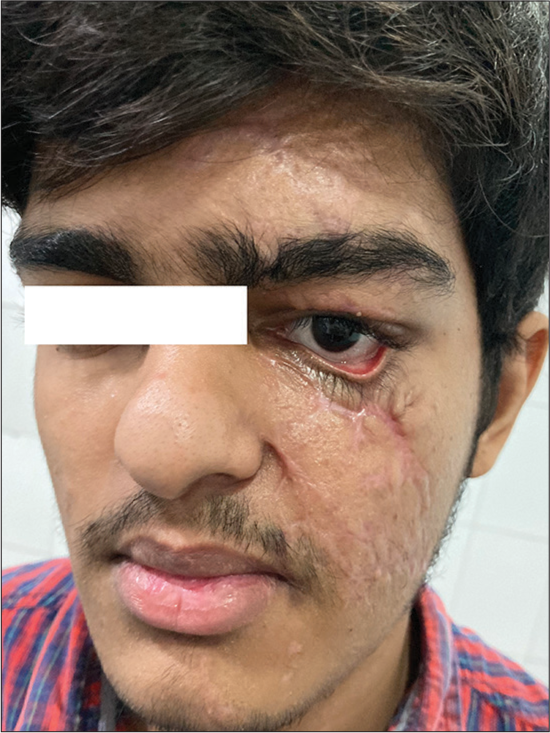 Traumatic ectropion with a scar on the cheek.