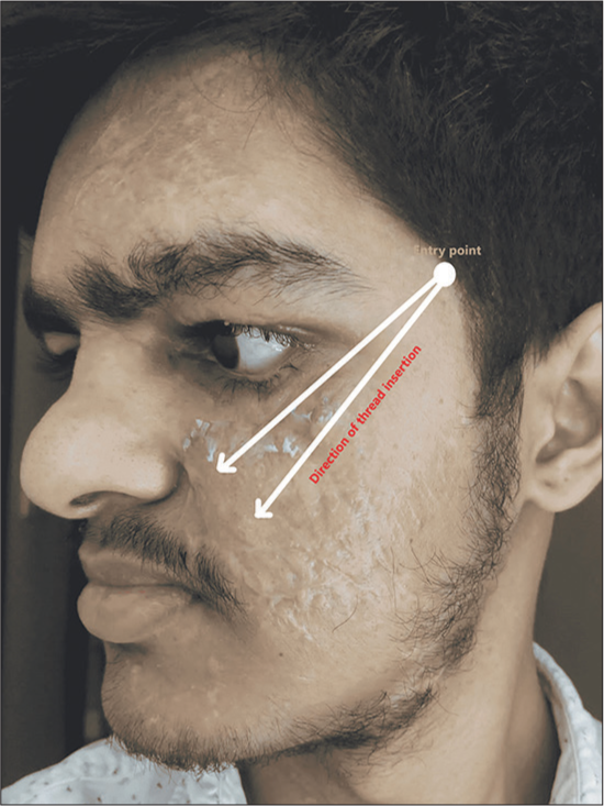 The figure shows the entry point and the direction of threads.