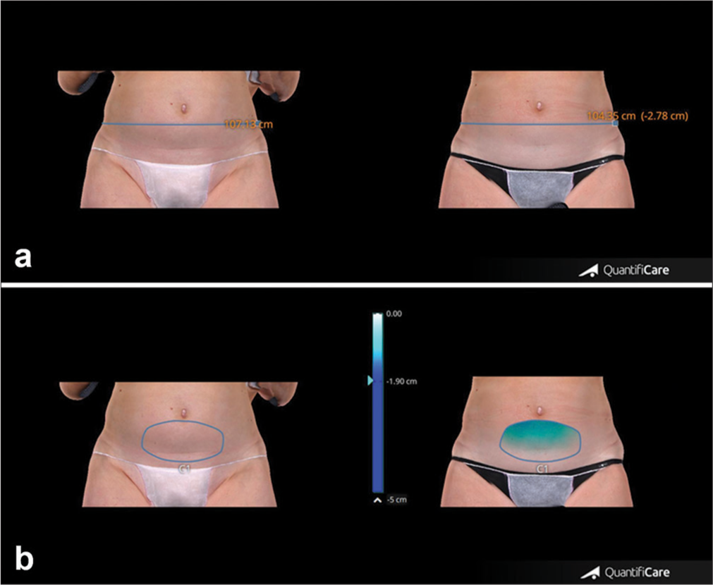 (a) Abdominal circumference measurements of patient at baseline and after 4 weeks from the last treatment session. (b) Abdominal volume change of the same patient at baseline and after 4 weeks from the last treatment session. Blue line: Thigh circumference, Blue circle: Thigh volume.