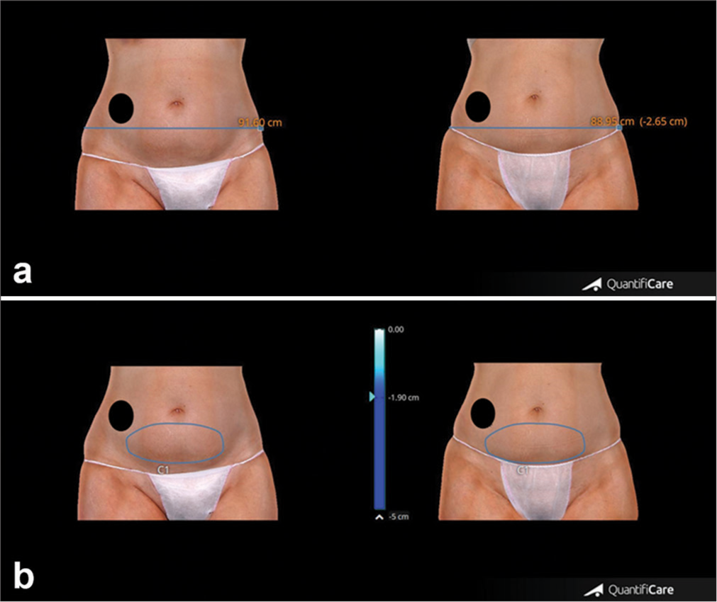 (a) Upper panel. Abdominal representative case showing circumference reduction, clinical improvement, and morphological changes of abdominal appearance before and after 4 weeks from the last treatment session. (b) Lower panel. Change of abdominal volume in the same patient before and after 4 weeks from the last treatment session. A black circle was added to the image to cover the patient’s tattoo for privacy protection. Blue line: Thigh circumference, Blue circle: Thigh volume.