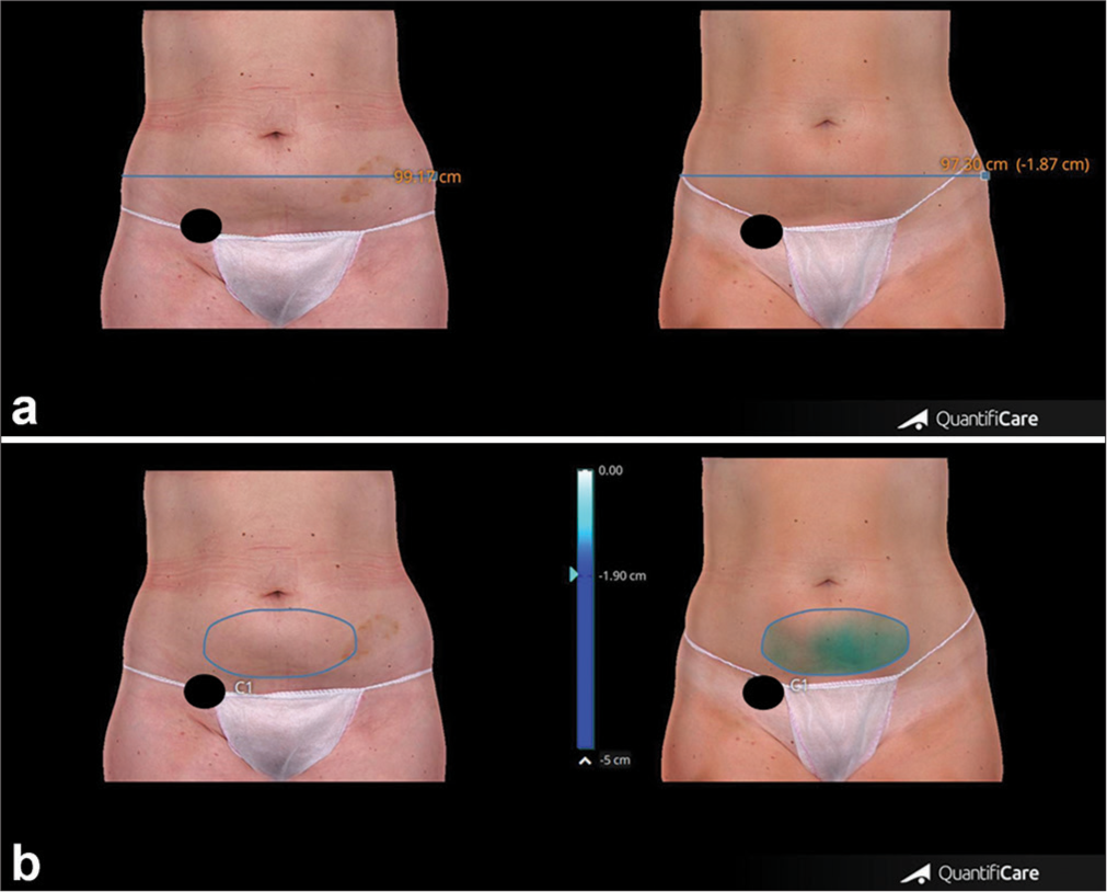 (a) Measurements of abdomen circumference reduction were taken before and after 4 weeks from the last treatment session. (b) Changes in abdominal volume measured before and after 4 weeks from the last treatment session. The black circle covers the patient’s tattoo for privacy protection. Blue line: Thigh circumference, Blue circle: Thigh volume.