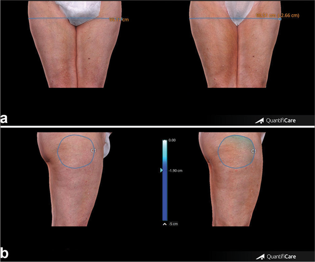 (a) Thigh circumference measures before and after 4 weeks from the last treatment session. (b) Thigh volume measures taken before and after 4 weeks from the last treatment session. Blue line: Thigh circumference, Blue circle: Thigh volume.