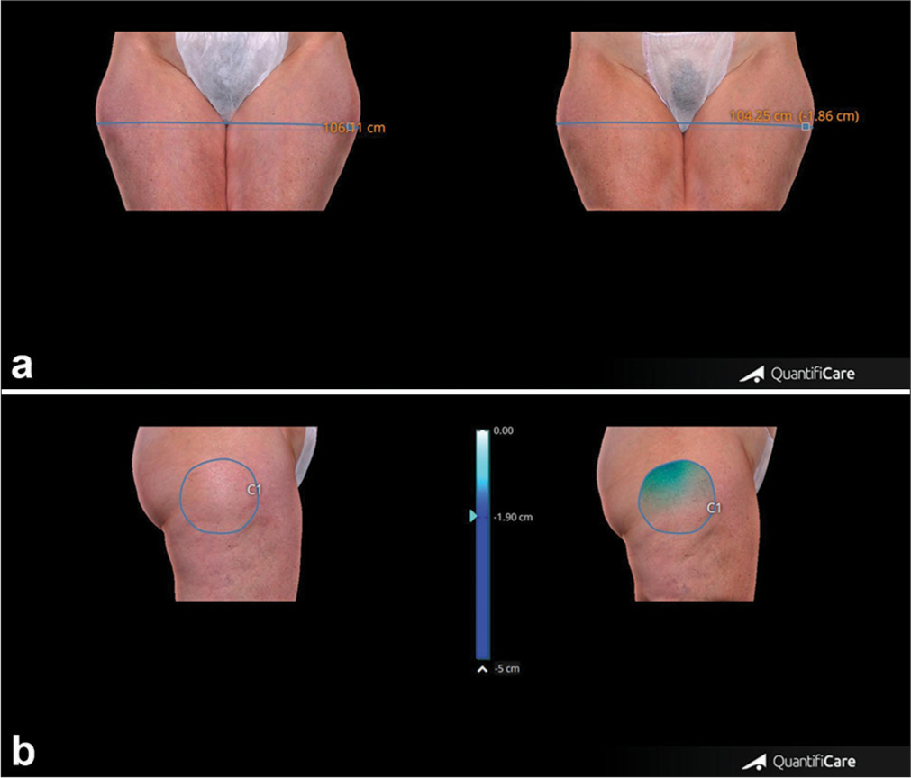 (a) Upper panel. Representative case showing circumference reduction, clinical improvement and morphological changes of thighs appearance before and after 4 weeks from the last treatment session. (b) Lower panel. Change of thigh volume in the same patient before and after 4 weeks from the last treatment session. Blue line: Thigh circumference, Blue circle: Thigh volume.