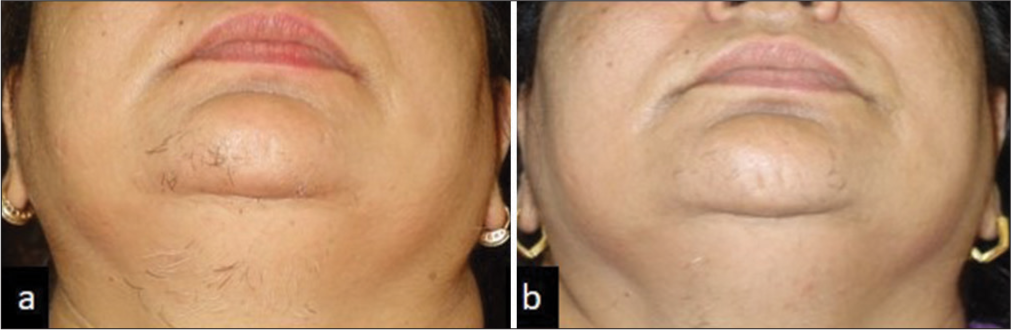 (a and b) Pre and post procedure pictures of leukotrichia treated with self-made insulated needle.