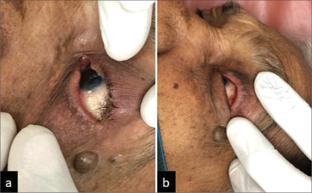 (a and b) Pre and post-procedure pictures of trichiasis treated with self-made insulated needle.