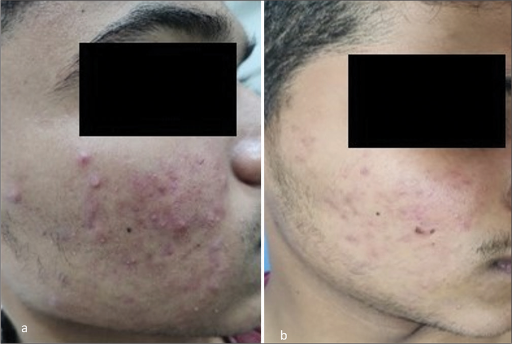 (a) Before and (b) after photographs of patient on isotretinoin monotherapy.