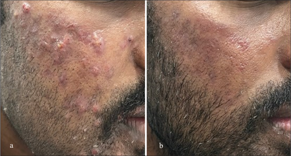 (a) Before and (b) after photographs of patient on isotretinoin monotherapy.