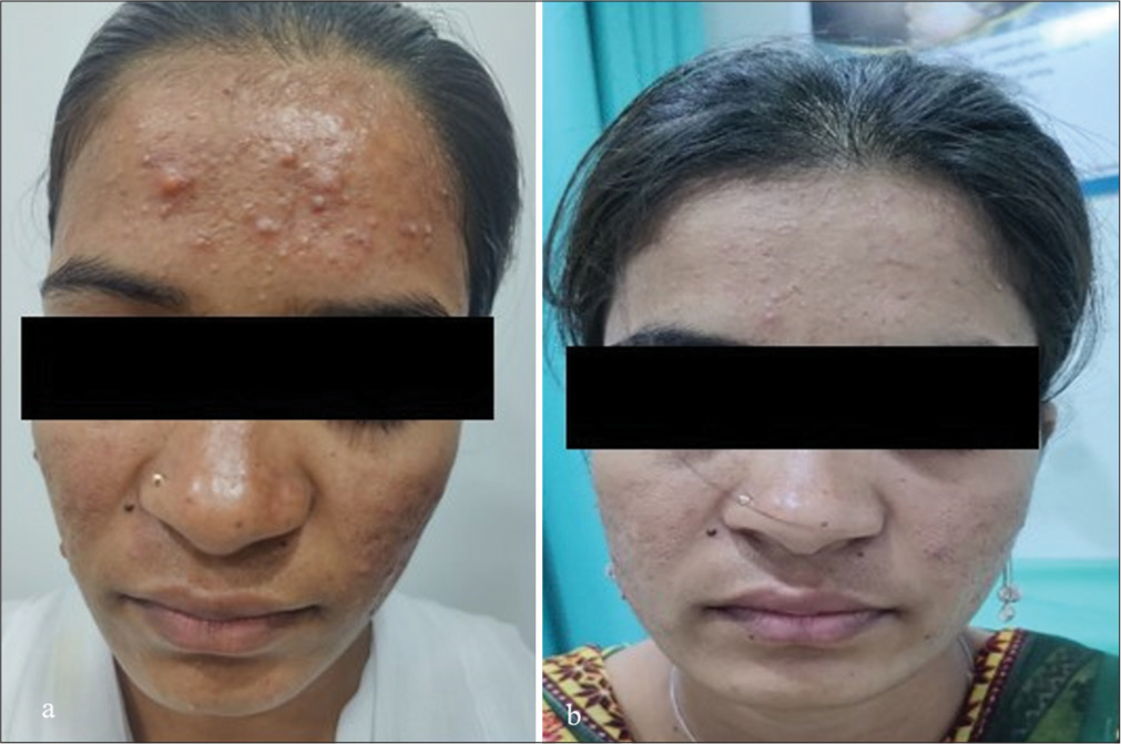 (a) Before and (b) after photographs of the patient on isotretinoin and sequential peel (30% salicylic acid followed by 25% glycolic acid).