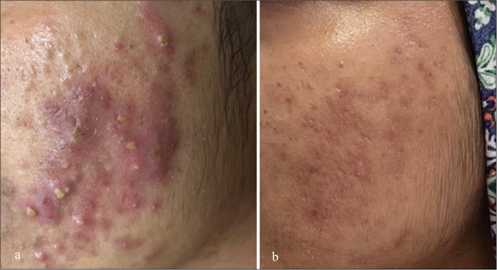 (a) Before and (b) after photographs of the patient on isotretinoin and sequential peel (30% salicylic acid followed by 25% glycolic acid).