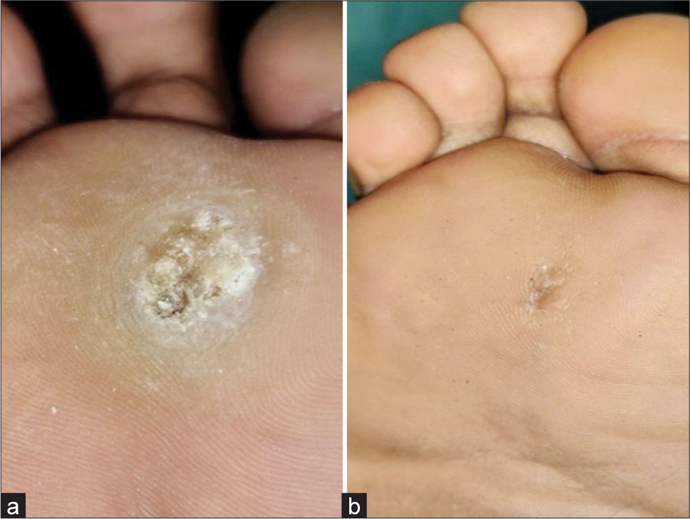 (a) Single-skin-colored plaque with a verrucous surface present on the sole of the right foot. (b) Complete clearance after 8 weeks of bleomycin treatment.