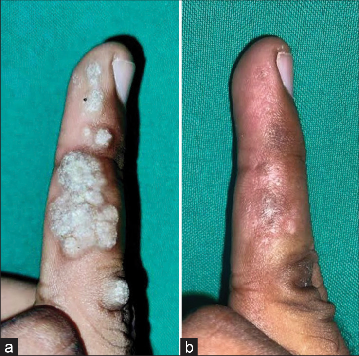 (a) Single plaque with a verrucous surface present over the middle finger of the right hand. (b) Complete clearance after 12 weeks of bleomycin treatment.