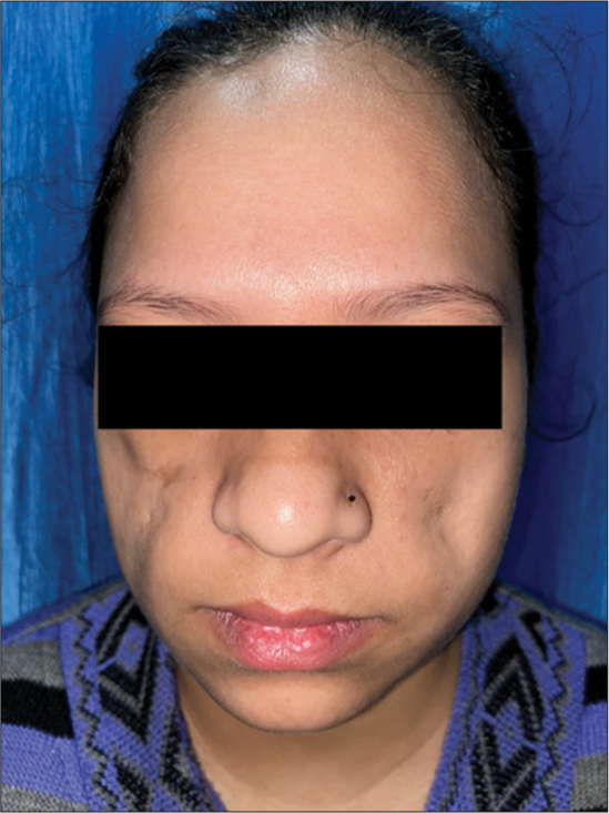 Bilateral loss of cheek fat pad.