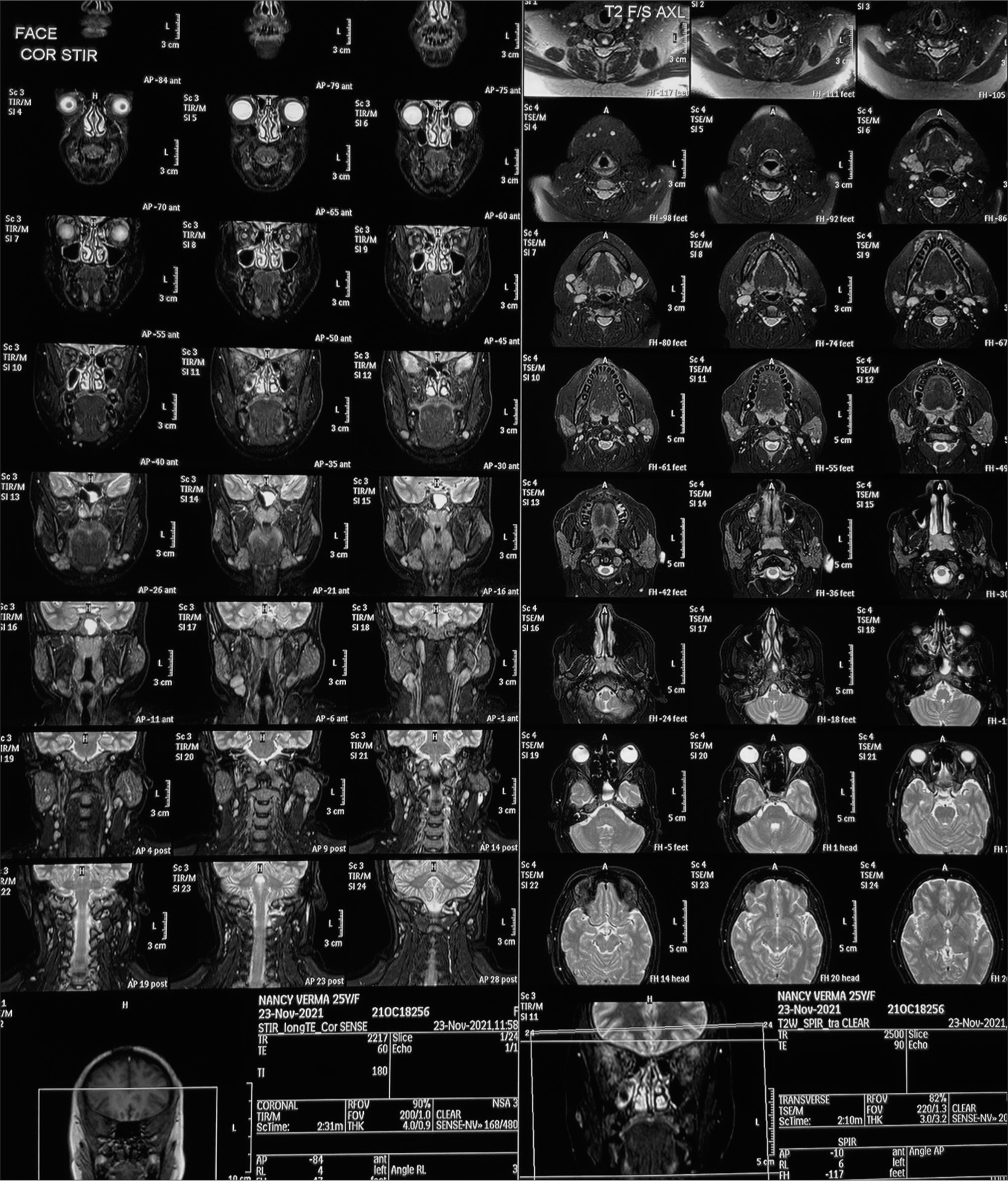 Magnetic resonance imaging shows loss of fat over the face area.