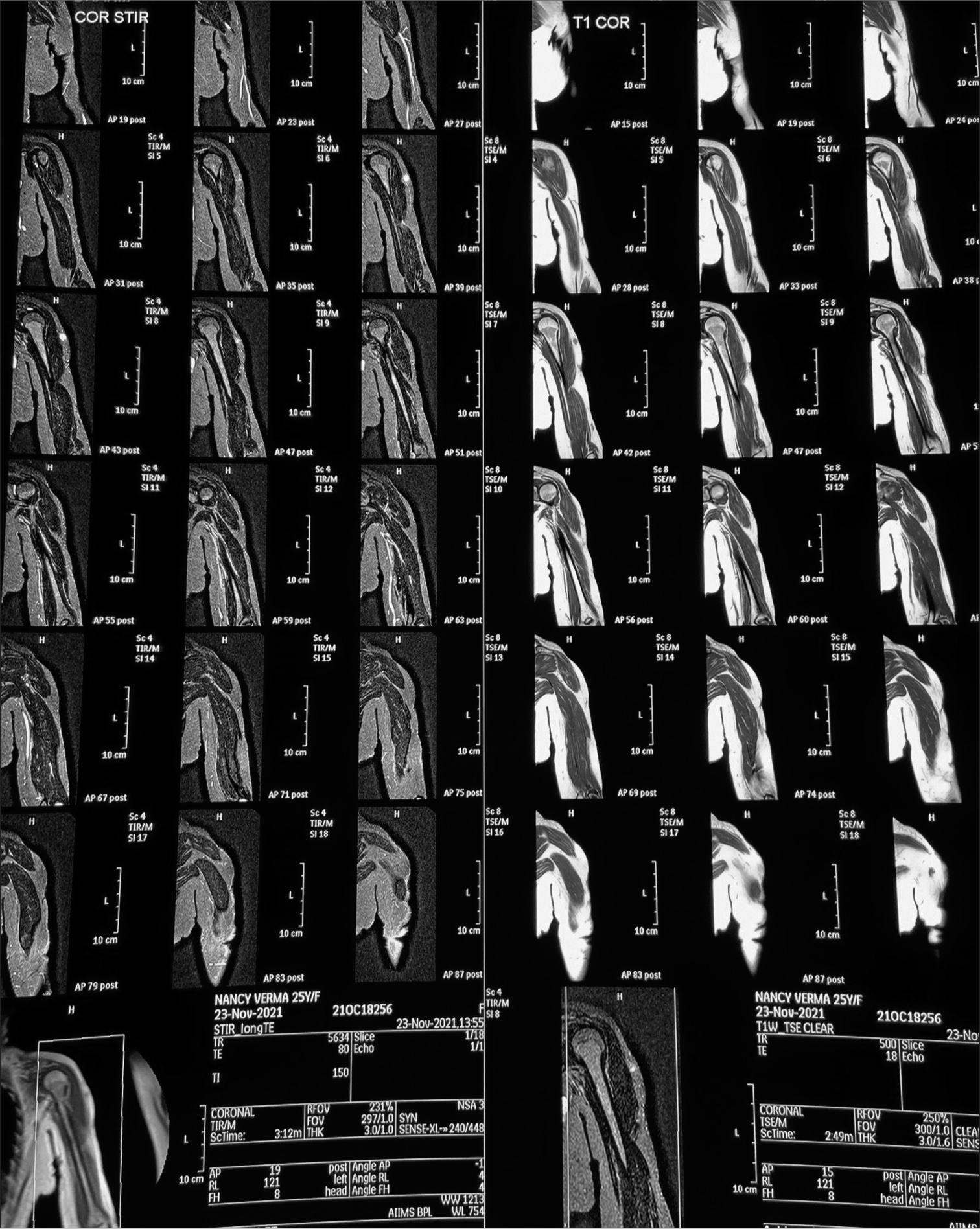 Magnetic resonance imaging depicts the loss of the subcutaneous layer over arms with preserved fat over the chest area.