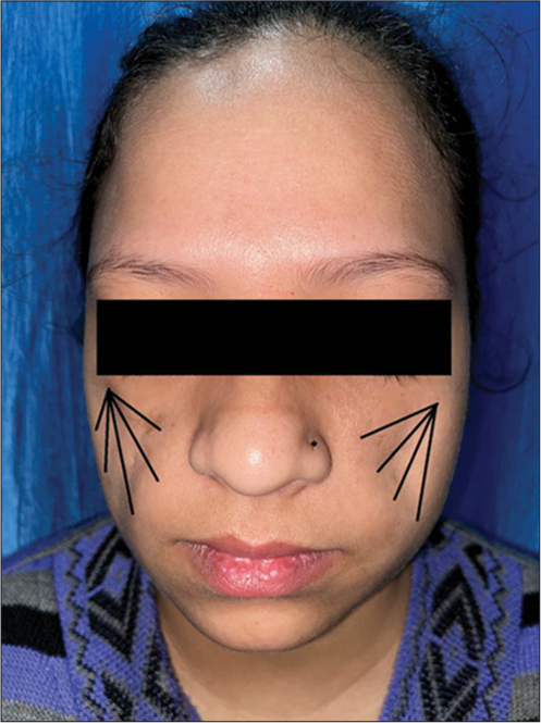 The bilateral cheek area was injected with fat along the direction as depicted (black lines).