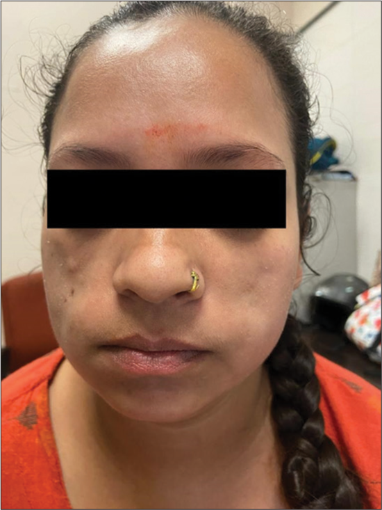 Loss of left cheek fat due to under-correction and preserved fat transplant at 6 months of follow-up.