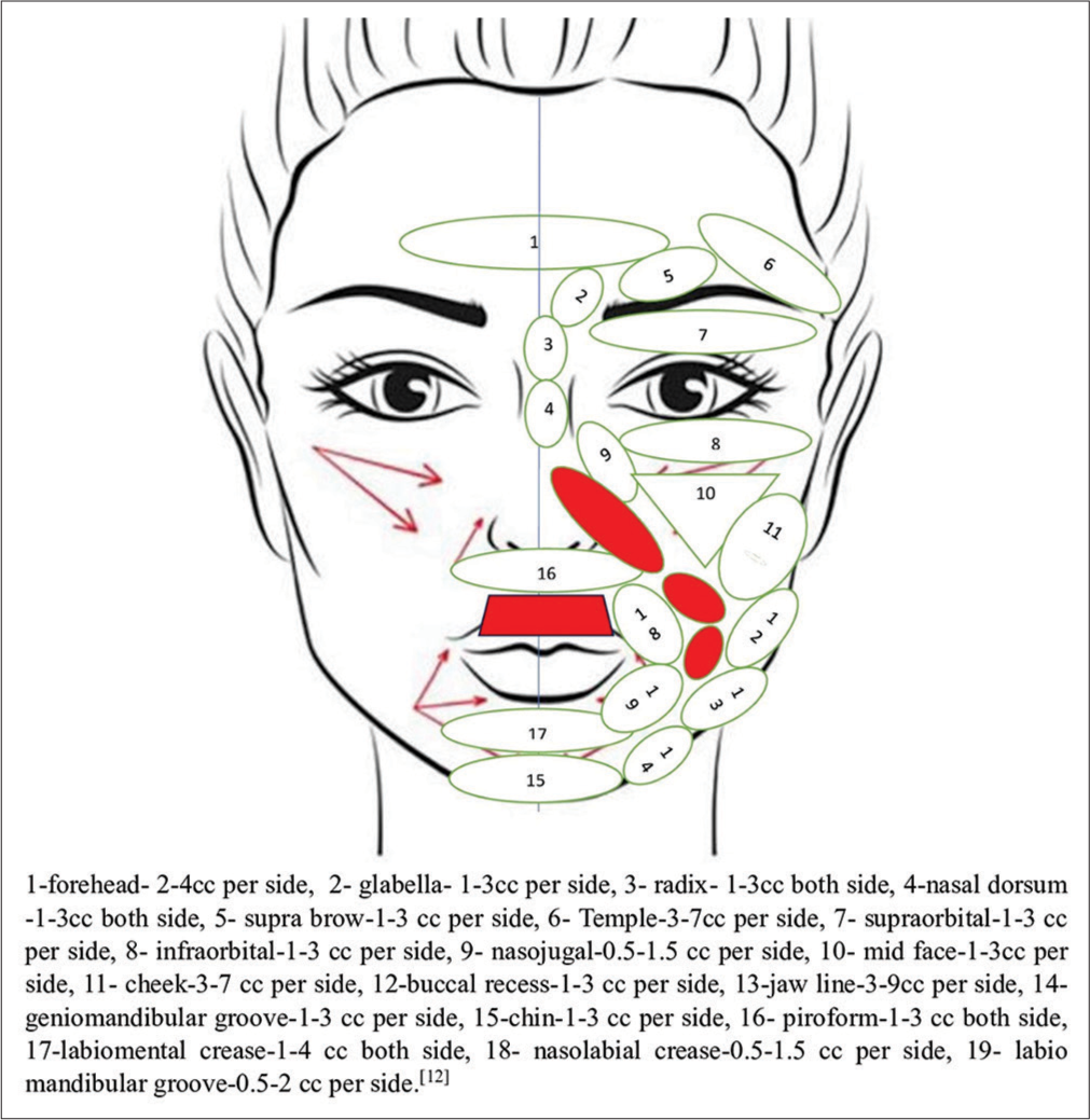 The volume of fat to be injected during micro-fat graft over the face area. Red highlighted areas indicate places where fat transplants are avoided, whereas red arrows indicate the direction of fat injection.