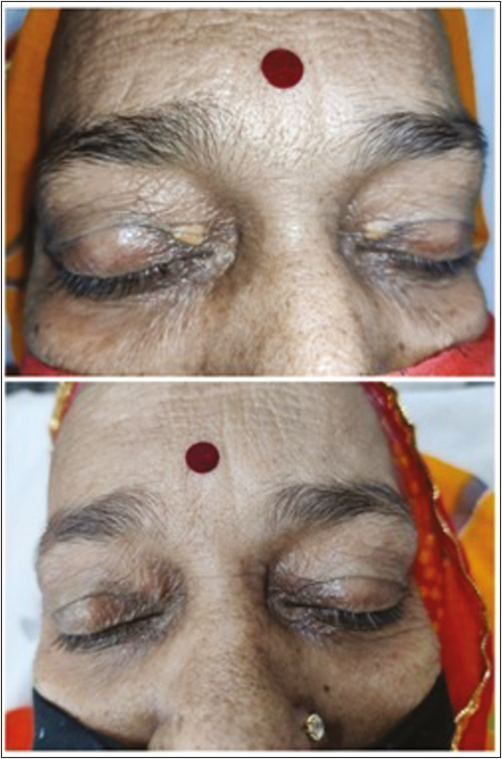 Pre and posttreatment images of a patient with grade 3 lesion after treatment with Erbium yag laser showing complete clearance without any adverse effects