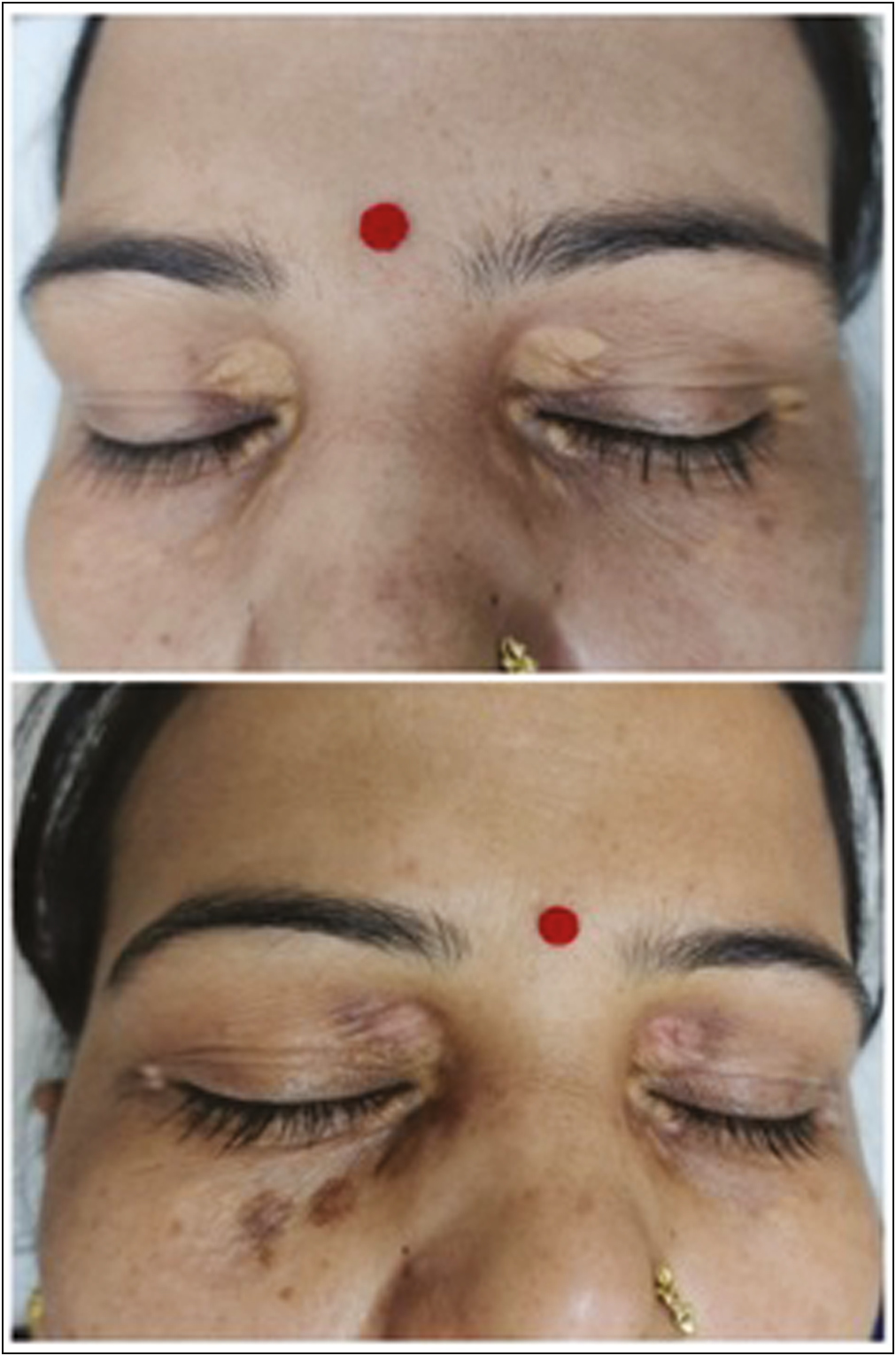 Pre and posttreatment images of patients with grade 3 lesions after treatment with TCA 50% showing partial response and postinflammatory hyperpigmentation